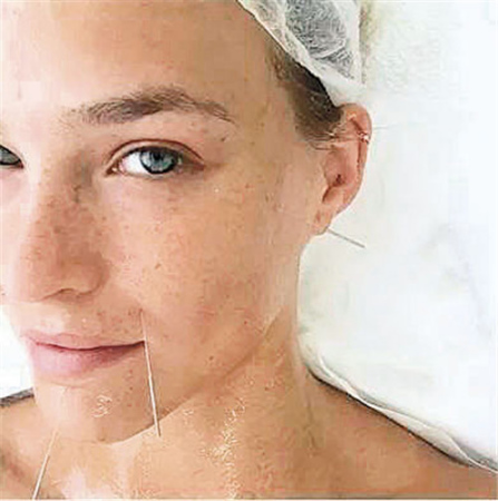 萊昂納多前女友、以色列內(nèi)衣超模芭兒·萊法利（Bar Refaeli）曾在社交平臺上分享了自己面部針灸時的樣子，照片中芭兒素顏正躺，臉上多個穴位規(guī)則布針。(美國《僑報》摘自網(wǎng)絡(luò)圖片)