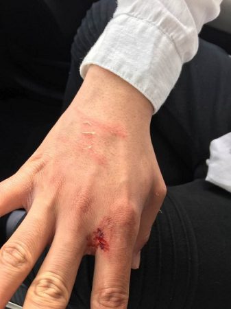 一名疑似西裔男子于21日下午進(jìn)入成先生在芝加哥華埠的租住房行竊被抓現(xiàn)行，住戶督先生手部受傷。(成先生提供) 