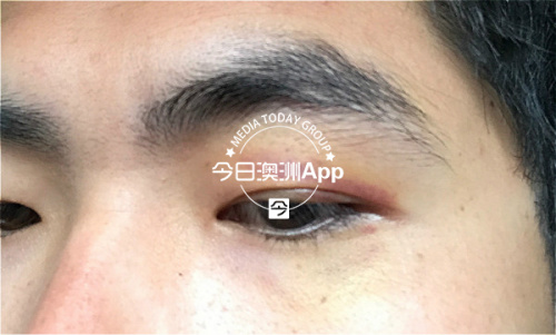 小陽被打傷1周后的照片