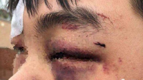 銳參考｜中國(guó)在這個(gè)國(guó)家的所有使領(lǐng)館，首次“群發(fā)”了同一個(gè)警告 遭受毆打的中國(guó)留學(xué)生(圖片源自澳媒)