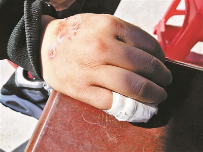陳強(qiáng)被燒傷的小手指已包扎好