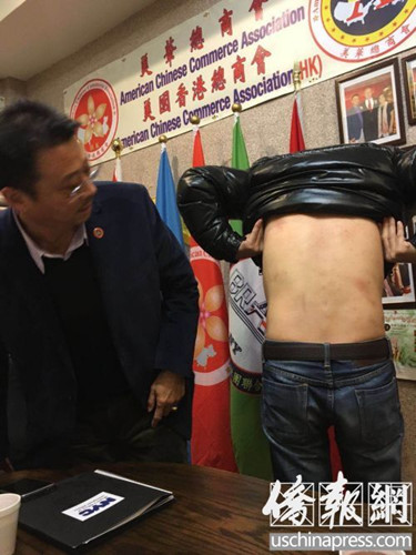 受害華青之一向布碌侖亞總會會長陳善莊求助,展示被打慘狀(僑報(bào)記者