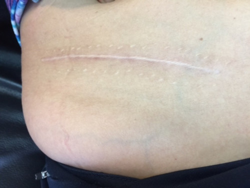 劉女士身上的其中一個(gè)傷口被縫了很多針。(美國《世界日?qǐng)?bào)》)