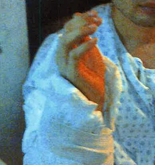 鄭先生自A字梯上摔下造成右手肘骨裂,傷勢嚴重。(美國《世界日報》)