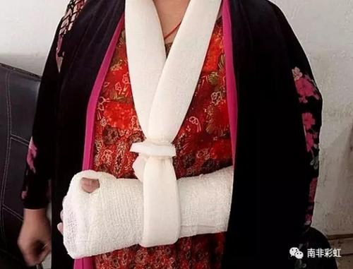 中國僑網(wǎng)受害者胳膊被歹徒擰斷,造成多處粉碎性骨折。(《南非華人網(wǎng)》)