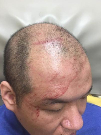 中國(guó)僑網(wǎng)莫名被毆打,江賢鋒渾身是傷。(美國(guó)《世界日?qǐng)?bào)》/黃伊奕 攝)