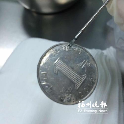 中國(guó)僑網(wǎng)取出的卡在食道的硬幣