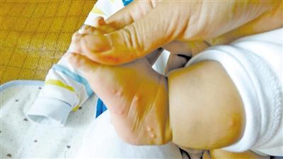 中國僑網(wǎng)水痘病人會出現(xiàn)全身性皮疹并發(fā)展到水皰疹。