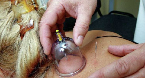 俄羅斯老人在中國進行中醫(yī)理療。(圖片來源:俄羅斯衛(wèi)星網(wǎng))