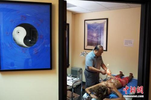 中國僑網(wǎng)資料圖:圖為在美國行醫(yī)20余年,身為清代著名中醫(yī)溫病學家吳鞠通的第七代傳人的吳寶林為患者拔火罐。中新社發(fā) 毛建軍 攝